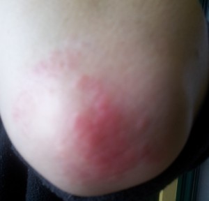 Luskavica na komolcu