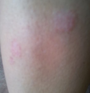 Skoraj suha luskavica na nogi